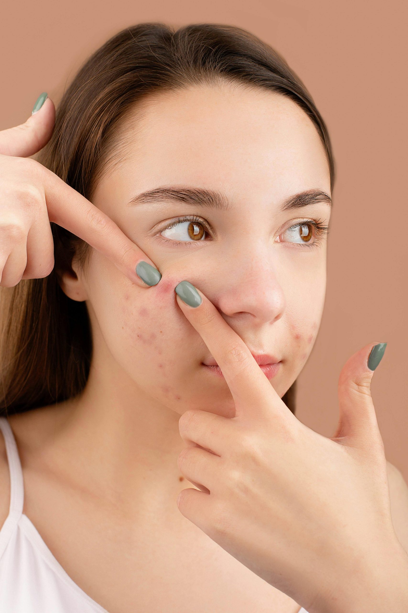 Skincare Routine for Acne-Prone Skin
