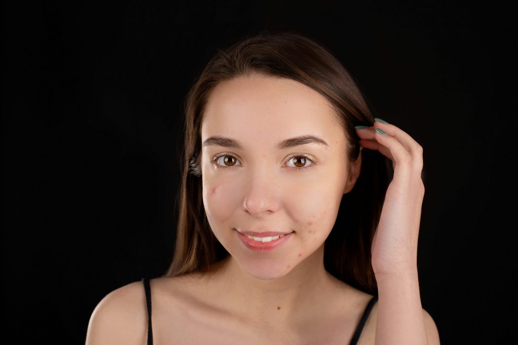 The Ultimate Guide to Fading Acne Scars: Professional vs. At-Home Methods
