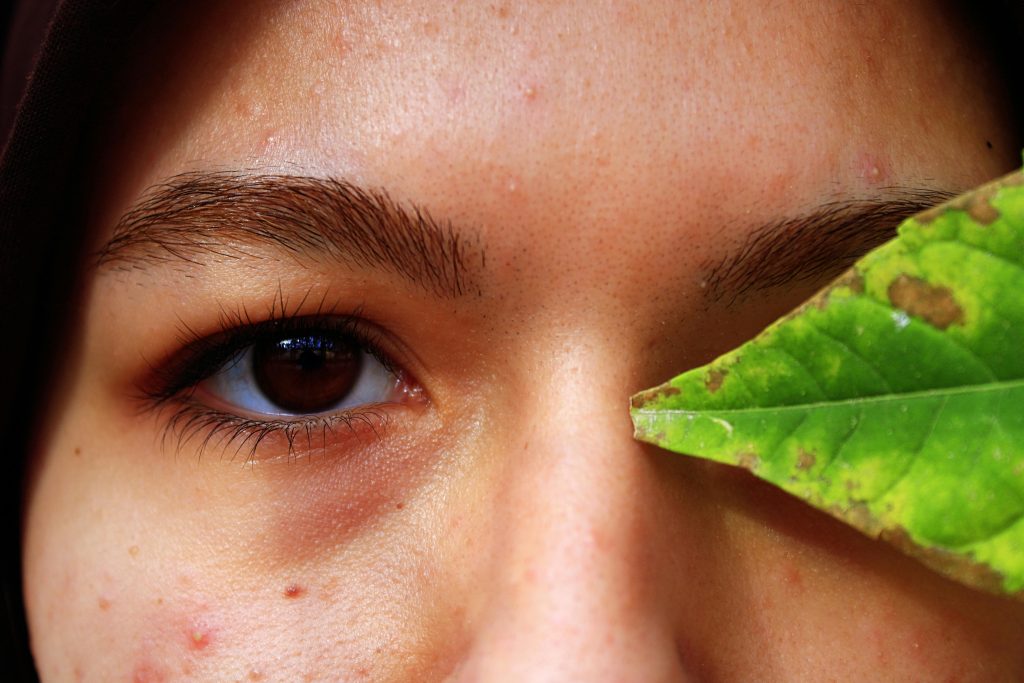 Fungal Acne Vs Bacterial Acne