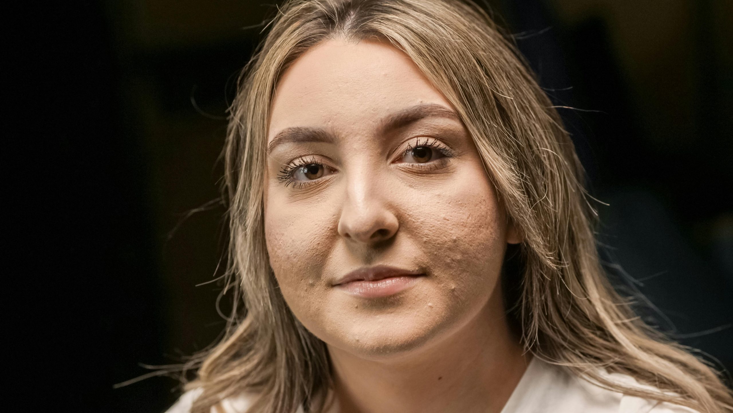 Cystic Acne