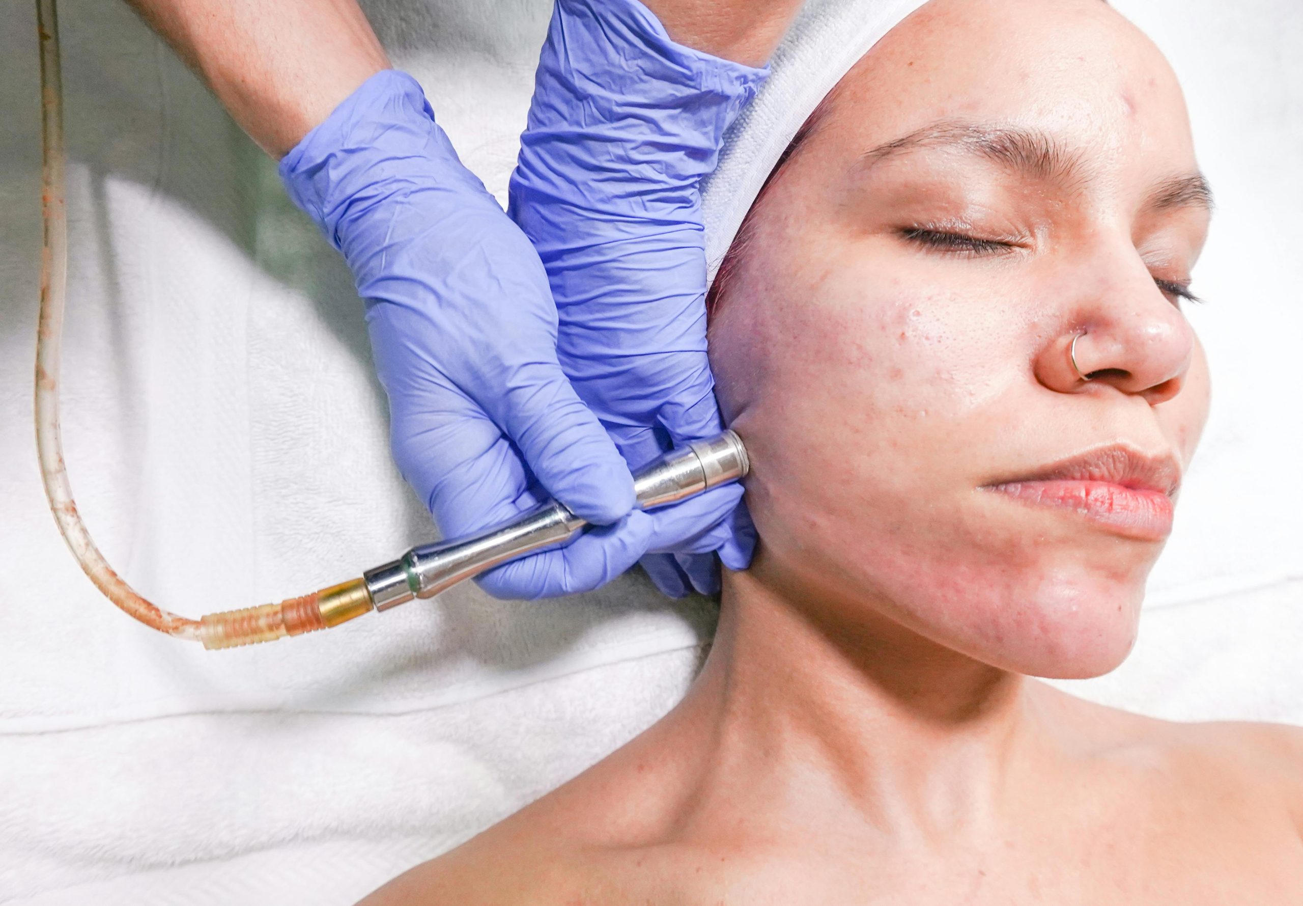 Cystic Acne on Oily Skin