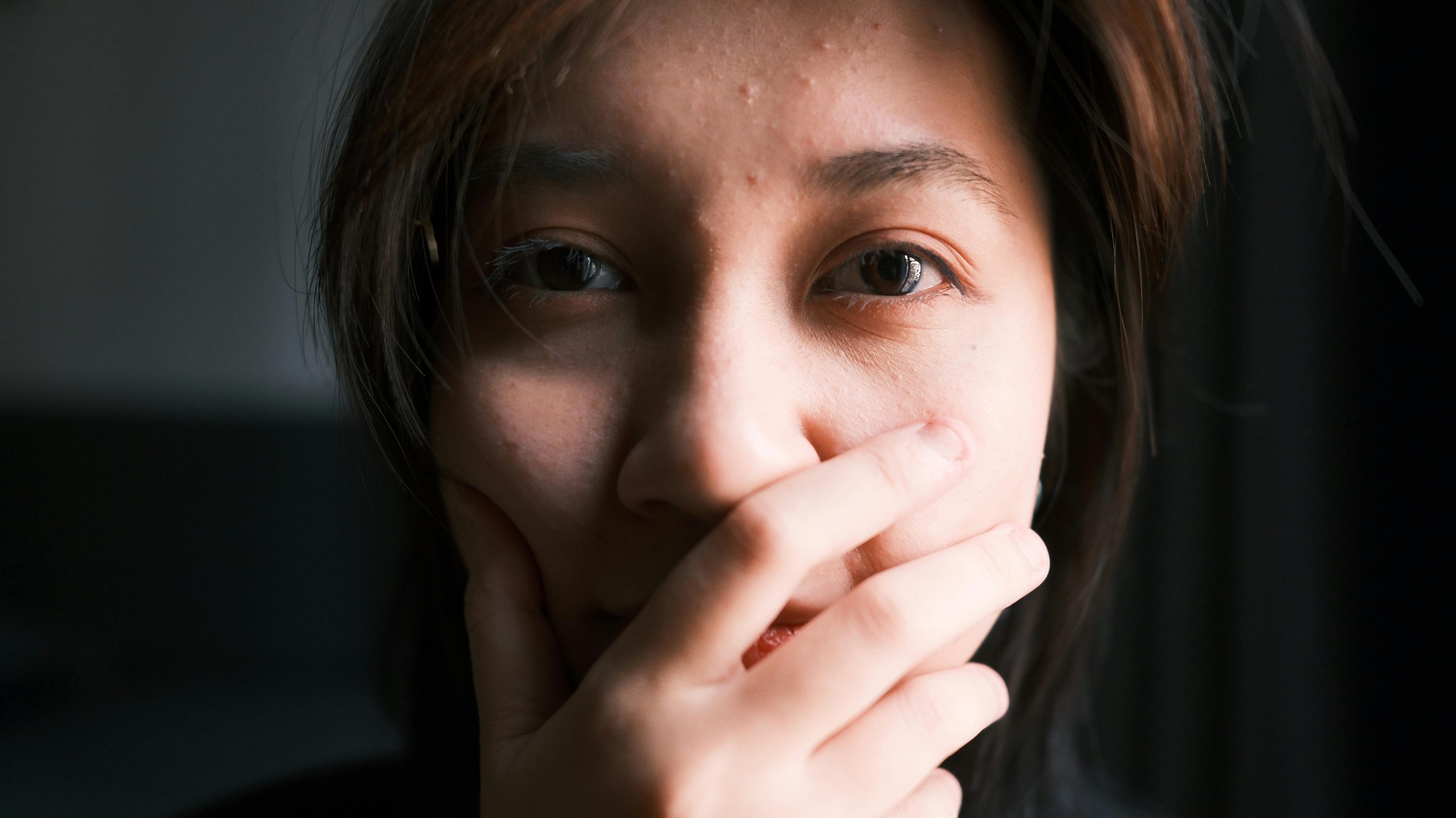 Fungal Acne on Forehead