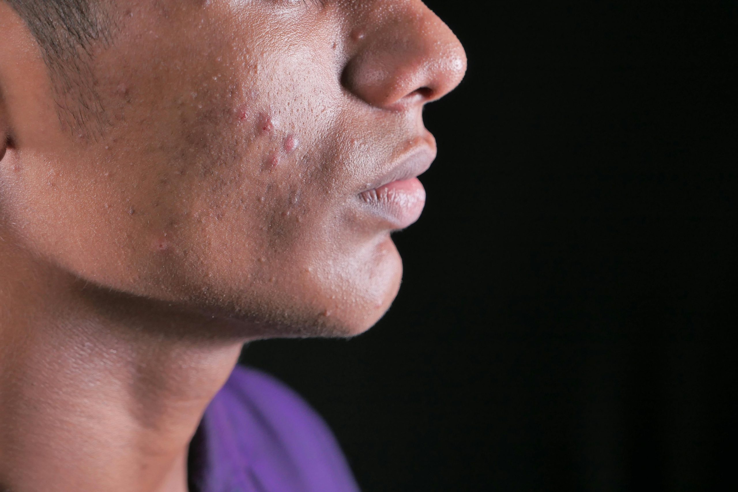 Fungal Acne Treatment