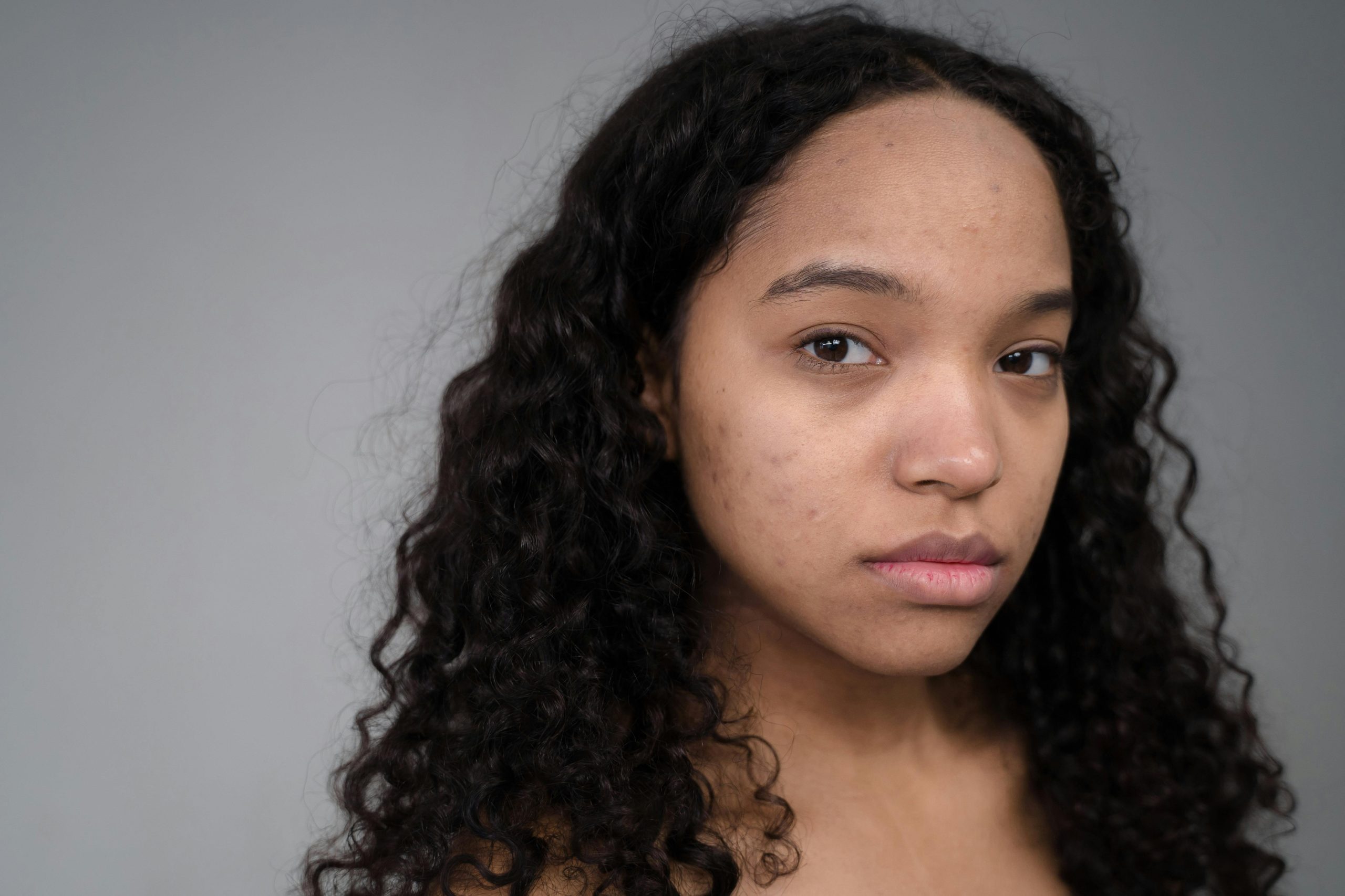 Retinol for Hormonal Acne